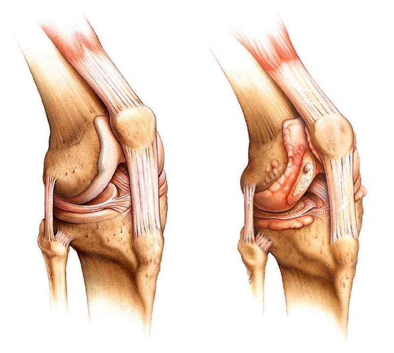 Articulation saine (gauche) et articulation arthritique (droite)