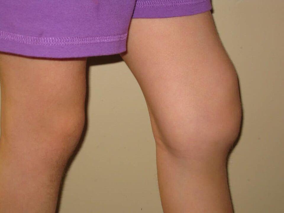 Pathologie du genou avec arthrose avancée