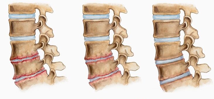 La déformation des disques intervertébraux dans l'ostéochondrose peut provoquer des maux de dos