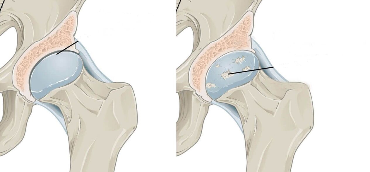articulation de la hanche saine et affectée avec arthrose