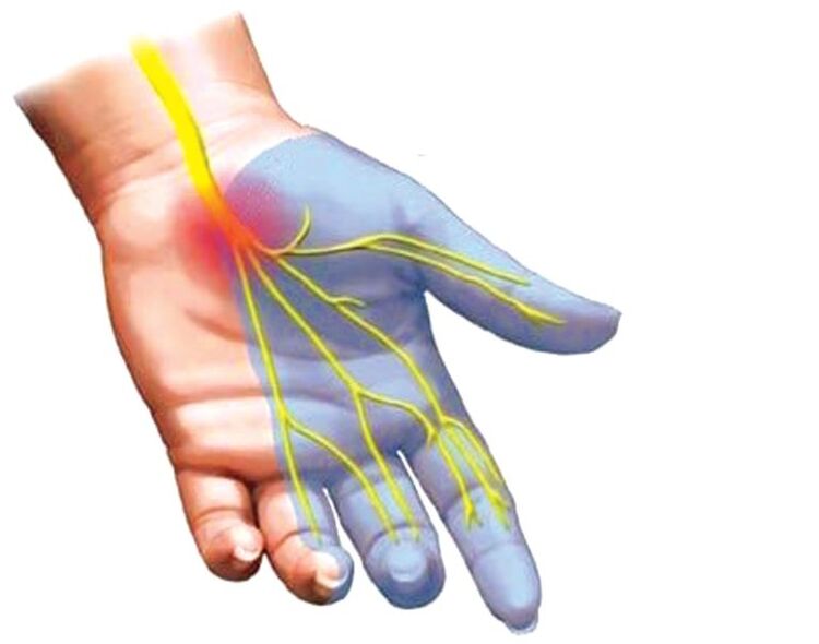 engourdissement des mains avec ostéochondrose