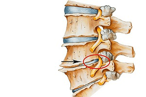 disque pincé de la colonne vertébrale comme cause d'ostéochondrose cervicale