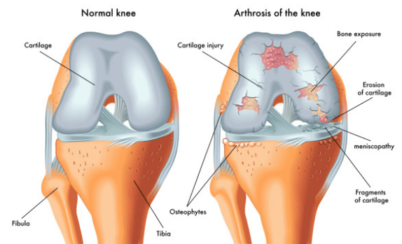 Joint normal et affecté par l'arthrose